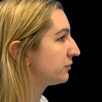 ultrasonic-rhinoplasty-before